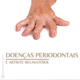 Doenças periodontais e Artrite Reumatoide