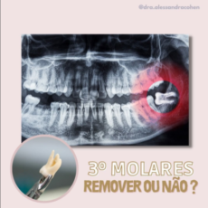 Os dentes do siso precisam mesmo ser removidos?