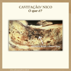 Cavitação / Nico? O que é?