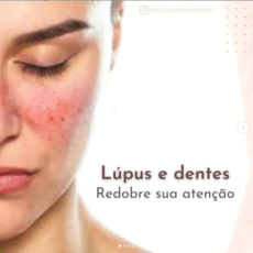 Lúpus e dentes – Redobre sua atenção