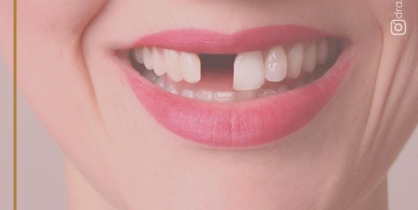 Ausência Dentária – O prejuízo vai além da estética