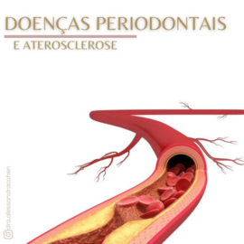 Doenças Periodontais e aterosclerose
