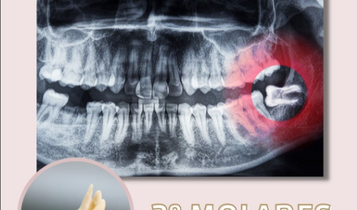 Os dentes do siso precisam mesmo ser removidos?
