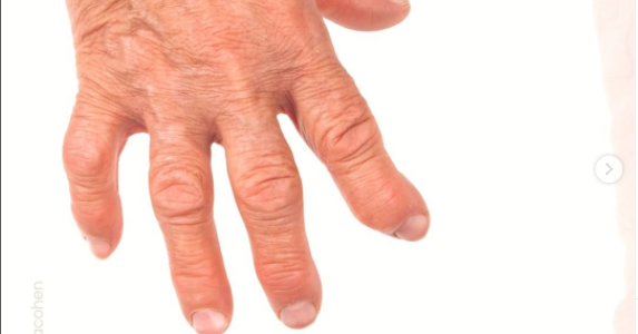 Artrite e dentes – Qual a relação?